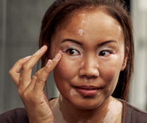 A person showing symptoms of nonsegmental vitiligo