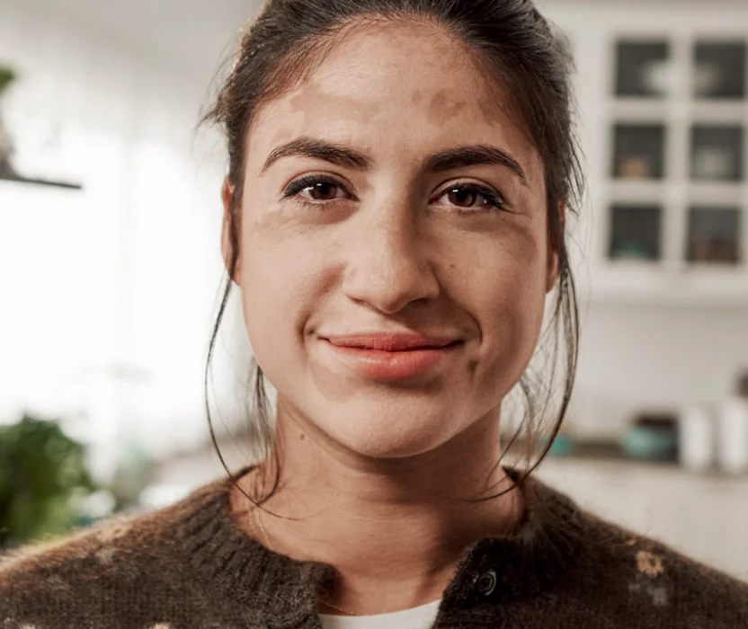 A person showing symptoms of nonsegmental vitiligo